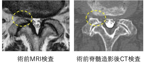 分厚くなった骨や靭帯によって神経が圧迫されている